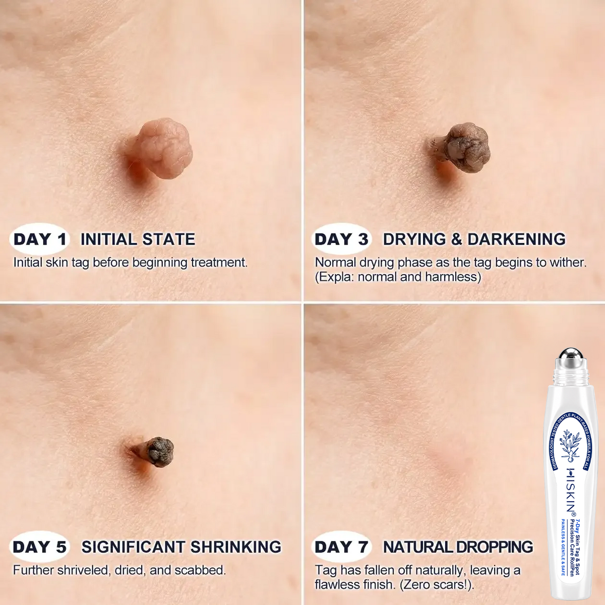 𝐇𝐈𝐒𝐊𝐈𝐍®👩‍⚕️ 𝟕-𝐃𝒂𝘆 𝐒𝗸𝐢𝐧 𝐓𝒂𝗴 & 𝐒𝐩𝙤𝐭 𝐄𝐫𝒂𝐬𝙚𝐫 Sans douleur & Scar-Free Advanced Imperfection Removal Rollerball Pen