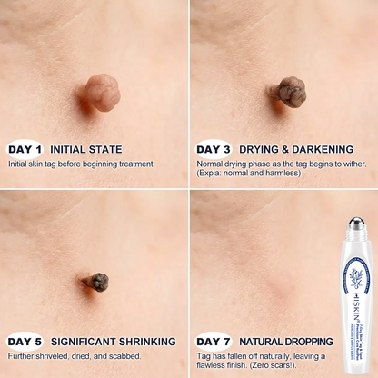 𝐇𝐈𝐒𝐊𝐈𝐍®👩‍⚕️ 𝟕-𝐃𝒂𝘆 𝐒𝗸𝐢𝐧 𝐓𝒂𝗴 & 𝐒𝐩𝙤𝐭 𝐄𝐫𝒂𝐬𝙚𝐫 Sans douleur & Scar-Free Advanced Imperfection Removal Rollerball Pen